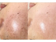 れふぇるん 足利店/30代 シミケア 施術１回