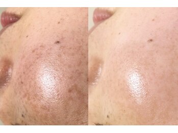 れふぇるん 足利店/30代 シミケア 施術1回