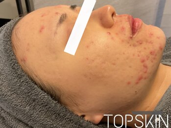トップスキン 名駅(TOPSKIN)/顎周りのニキビにTCLINEハーブ♪