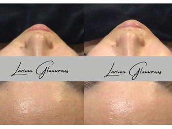 ラリマ グラマラス(Larima Glamorous)/毛穴洗浄・角栓しっかり洗浄