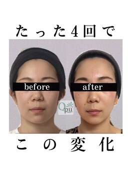キュープ 柏店(Qpu)の写真/小顔頭蓋骨矯正+オイルコースを体験して輪郭すっきり!丁寧な施術でフェイスラインを整える贅沢な時間を◎