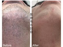 CDF 赤坂/メンズヒゲ脱毛6回目初回￥1000