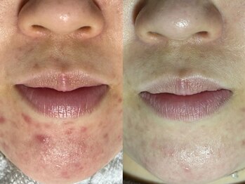 リボーン(REBORN)/徹底ニキビケア