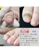 ドクターネイル爪革命 長野店/《施術不可能な場合の参考例》