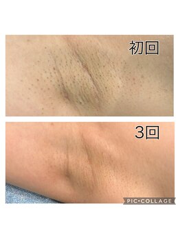 レイモード(Ray mode)/全身脱毛+VIO爆抜け