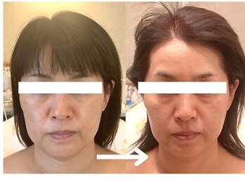 シベル(Si Belles)/1回でフェイスラインがキュッ!