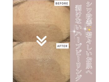 サロンアールミヨン(Salon R Miyon)/ハーブピーリング