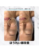 エクラ 六本木(eclat)/プラズマフェイシャル