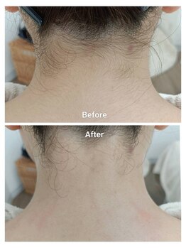 ノト(NOTO)/うなじ脱毛