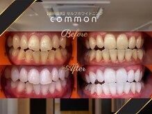 セルフホワイトニングコモン 藤枝店(self whitening common)