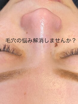 ラナ(Lana)/今話題の毛穴エクストラクション