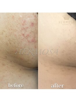 ピアーノ(PIANO)/ボディハーブピーリング