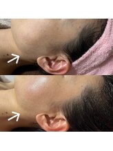 ブーケ(bouquet)/エラ張りに