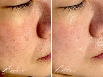 ミモア(mimoi.)/フェイシャルWAX