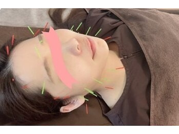 いとう鍼灸整体院 代官山恵比寿/美容鍼