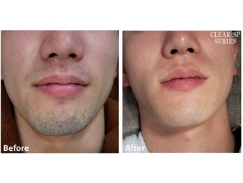 ロカビリー(Rockabilly)/メンズ　ヒゲ脱毛