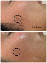 シェリアン(Cherien)/陶肌ハーブピーリング