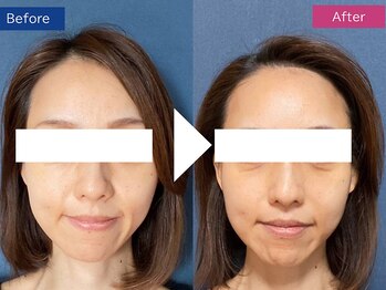 ビースト 下北沢店(B-st.)/フェイシャル｜全顔1回