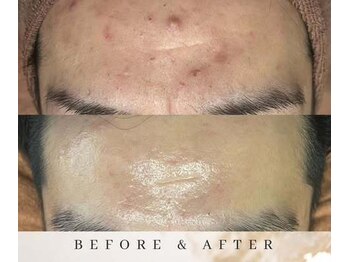 ゼロ アンド リセット(0ZERO&RESET)/【ララピール】Before・After