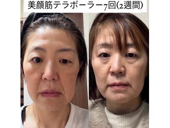 ソルテシュガーリング(SORTE sugaring)/テラボーラー/中顔面短縮にも!?