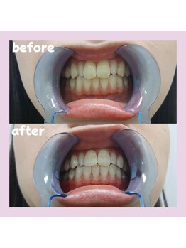 パレ 大阪十三店(Palet)/2回照射後のbefore/after