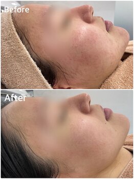 スハダビ110(suhadabi110)/before after