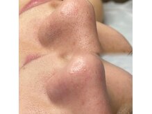 アトリーチェ(ATTRICE)の雰囲気（敏感肌や赤み肌の方も問わず通える毛穴ケア♪）