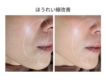 エボルブ 四条烏丸店(EVOLVE)の雰囲気（しぼみ肌タイプのほうれい線にも結果！リフトアップ効果も◎）