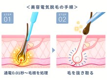 リムーブ(ReMove)の雰囲気(極細のプローブを挿入して1本ずつ脱毛します☆)