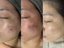 モナートドゥ(Monartdeux)の雰囲気(元ニキビ肌エステティシャンによる結果重視の肌質改善)