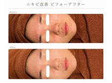 ベベ もりの里店(Be'be')の雰囲気（ニキビ改善ビフォーアフター）