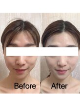 サロン ド シャーロット 恵比寿/韓国肌管理＃水玉SONO(LDM)