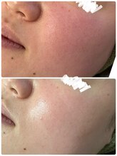 スナグル(Snuggle)/REVIハーブピーリング