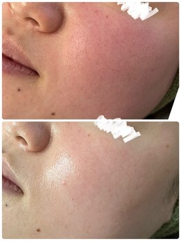 スナグル(Snuggle)/REVIハーブピーリング