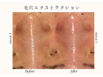 サロンドエー 帝塚山(Salon de A)/人気の!毛穴エクストラクション