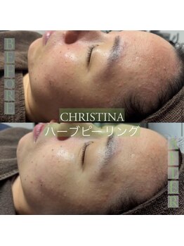 リリーブー 池袋(Lilyboo)/CHRISTINA ハーブピーリング