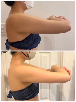 ルナグランデ 心斎橋店(Luna grande.)/二の腕脂肪撃退