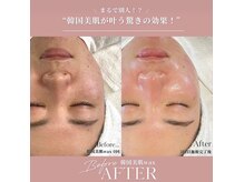 ジョリー(JOLi)/顔脱毛/韓国美肌ワックス