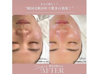 ジョリー(JOLi)/顔脱毛/韓国美肌ワックス