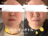 【半永久的に小顔効果】韓国で話題/レモンボトル フェイシャル(顎下・頬)