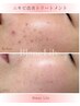 【集中！ニキビケア】ニキビ卒業★アクネピーリング9700