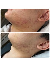 エミレーブ シロカネ(Hemireve Shirokane)/コンプレックス解消！