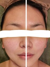 サロン ドゥ メビウス 春日店(salon de mebius)/小顔☆フェイスライン