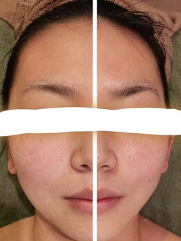 サロン ドゥ メビウス 春日店(salon de mebius)/小顔☆フェイスライン