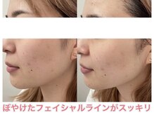 サクラ 伊勢原店(SAKURA)/キメ/美白/透明感◎