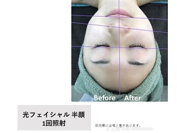 ヴィヴィオドット(vivio.)/葛城市で光フェイシャルするなら