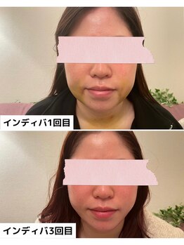 リリー(LILY)/お顔吸引の術後ケア