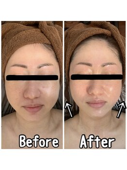 ブランシュール/ハイドラ×小顔タイト