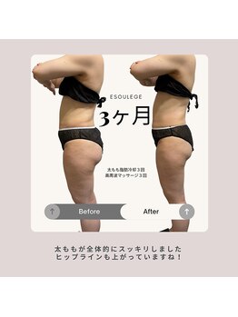 エスラージュ(esoulage)/脂肪冷却　Before After