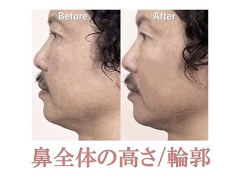 ラプリ 新宿店(Raplit)/隆鼻+輪郭矯正40分20回